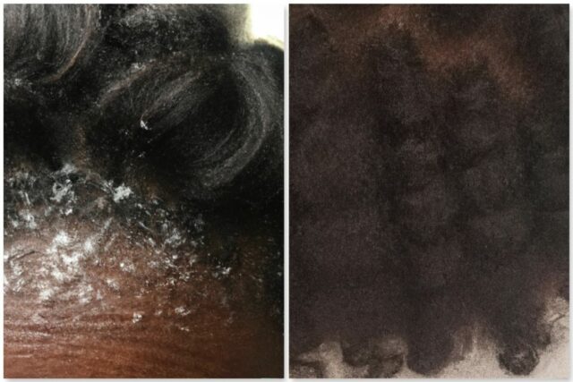 Dandruff Vs Dry Scalp: What Is The Difference & What Can You Do About It