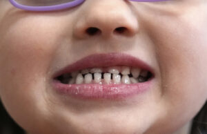 RFK Jr. anuncia un plan para hacer que las cavidades sean grandes nuevamente FILE - A child shows off her teeth after a dental exam in Concord, N.H., Wednesday, Feb. 21, 2024. (AP Photo/Robert F. Bukaty, file)