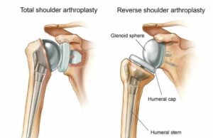 Insights del cirujano de Singapur – Reemplazo de hombro inverso | Indonesia fisioactiva Singapore Surgeon Insights - Reverse Shoulder Replacement | PhysioActive Indonesia