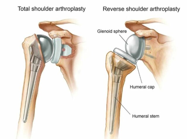 Singapore Surgeon Insights - Reverse Shoulder Replacement | PhysioActive Indonesia