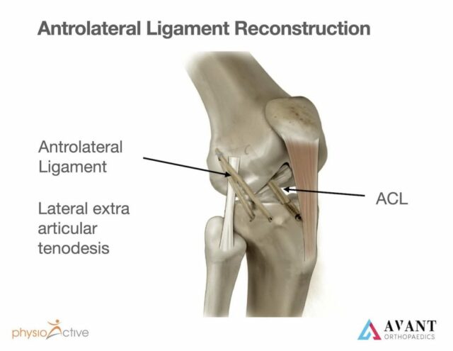 ACL Repair / Reconstruction with Dr Ramesh Subramaniam | PhysioActive Indonesia