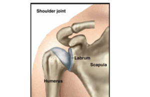 Lesión de hombro congelado y manguito rotador – Dr. Andy Wee | Indonesia fisioactiva Frozen Shoulder and Rotator Cuff Injury – Dr Andy Wee | PhysioActive Indonesia