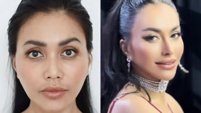 Los rangos de artistas indonesios experimentan francamente la operación de la rinoplastia y sus razones

