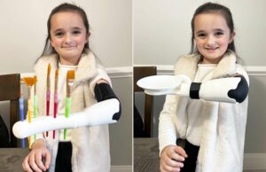 El graduado universitario construyó un brazo protésico para la hermana pequeña con un miembro de un miembro (exclusivo) El graduado universitario construyó un brazo protésico para la hermana pequeña con un miembro de un miembro (exclusivo)