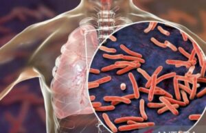 El 14 por ciento de los pacientes con tuberculosis en el norte de Yakarta disminuyeron el tratamiento El 14 por ciento de los pacientes con tuberculosis en el norte de Yakarta disminuyeron el tratamiento