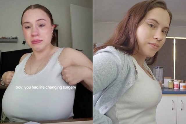 La mujer se vuelve viral en Tiktok por compartir la La mujer se vuelve viral en Tiktok por compartir la historia de la reducción de los senos de "salvación de vidas". Vea las fotos antes y después (exclusivo)