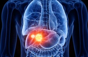 Reconocer los riesgos, los síntomas y los avances del tratamiento moderno del cáncer de hígado Reconocer los riesgos, los síntomas y los avances del tratamiento moderno del cáncer de hígado