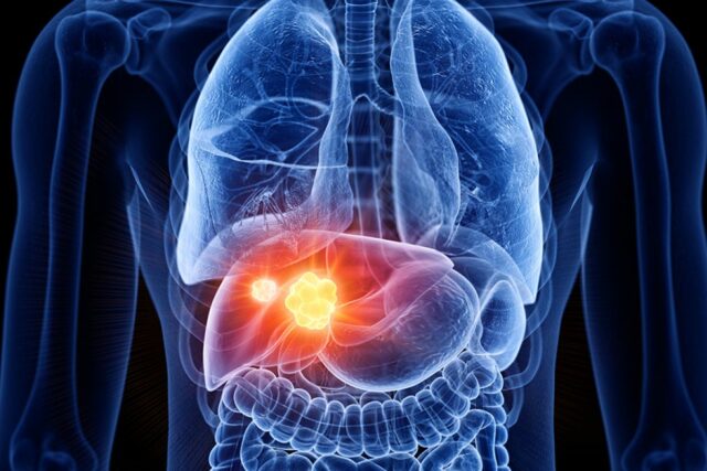 Reconocer los riesgos, los síntomas y los avances del tratamiento moderno del cáncer de hígado

