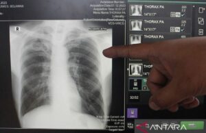 West Yakarta observó 2,189 casos de TB desde el comienzo de 2025 West Yakarta observó 2,189 casos de TB desde el comienzo de 2025