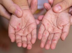 El Ministerio de Salud recuerda la alerta de sarampión antes de las vacaciones del Eid
| El Ministerio de Salud recuerda la alerta de sarampión antes de las vacaciones del Eid
|