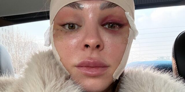 Me hice un lavado de cara cuando tenía treinta años. Fui a Corea del Sur para esto.

 | Health,as-told-to,health,cosmetic-surgery,millennial,seoul,plastic-surgery,mini-facelift