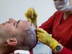 ¿Por qué los trasplantes de cabello son tan caros?
| Health,video,so-expensive,video-format-so-expensive,new-this-week,new-this-week-video ¿Por qué los trasplantes de cabello son tan caros?
| Health,video,so-expensive,video-format-so-expensive,new-this-week,new-this-week-video