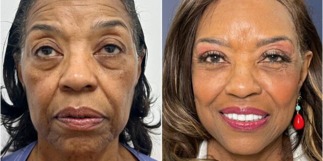 Se hizo un lavado de cara de 102.000 dólares a los 71 años; Ojalá hubiera podido permitirme esto hace diez años.

 | Health,as-told-to,health,plastic-surgery,los-angeles,hot-at-work