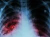 Ministro de Salud sugiere que personas con tuberculosis reciban MBG
| Ministro de Salud sugiere que personas con tuberculosis reciban MBG
|