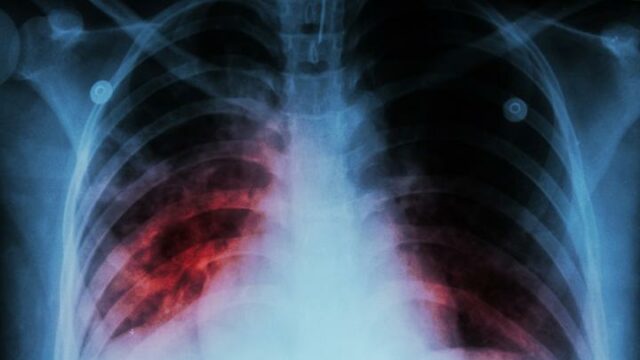 Ministro de Salud sugiere que personas con tuberculosis reciban MBG

 | 