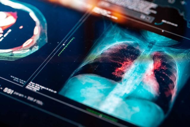 "El reinado del rey Keytruda continúa". Los inversores no están "El reinado del rey Keytruda continúa". Los inversores no están impresionados con un nuevo y prometedor fármaco contra el cáncer de pulmón.
|